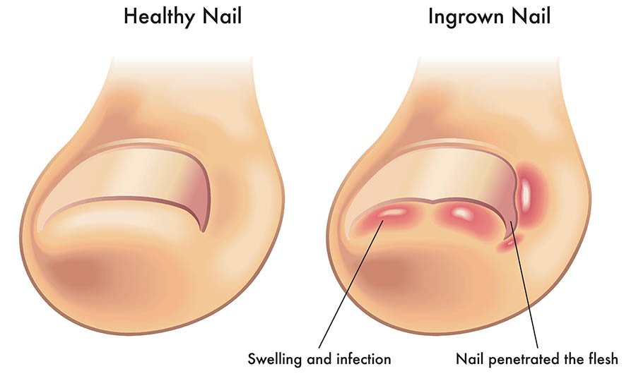 medical illustration of the symptoms of ingrown nail